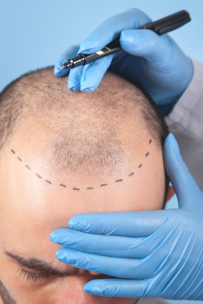Basic Hair Restoration Services Hair Growth Treatments